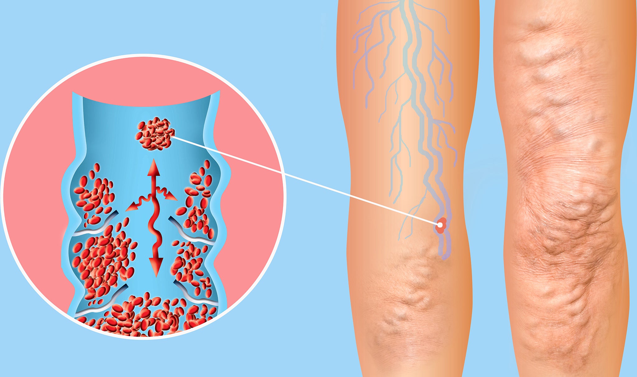 Treatments for varicose veins (III): the secrets of compression
